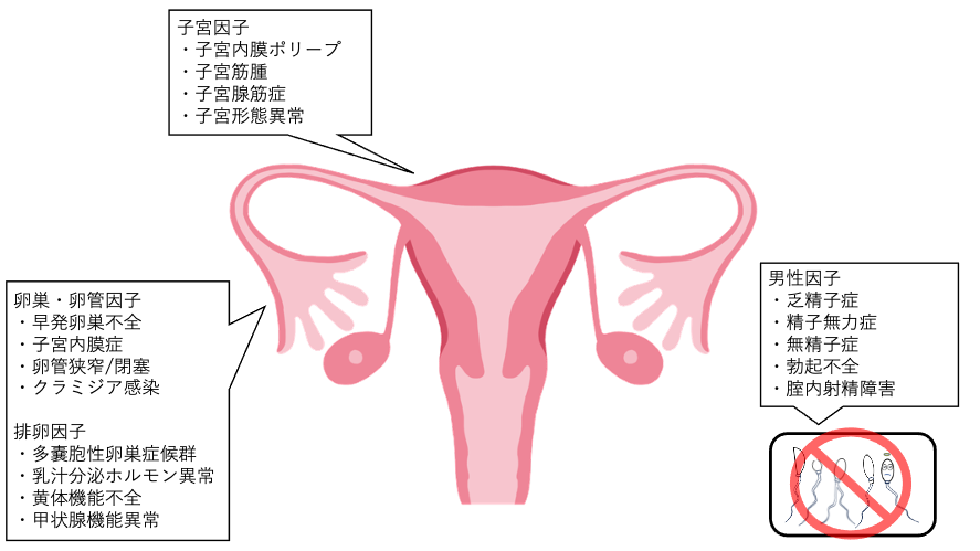不妊症の原因