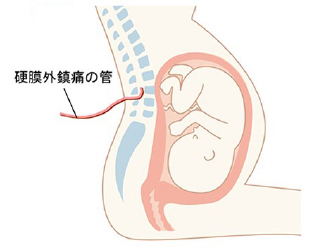 お母さんの背中に入った硬膜外鎮痛の管